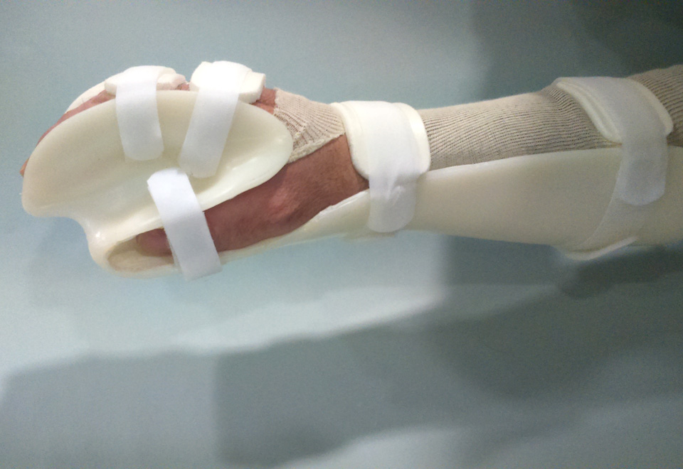Prótesis para personas sin dedos que facilitan las tareas cotidianas 